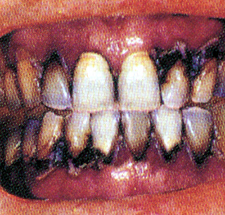 Teeth full Nicotine